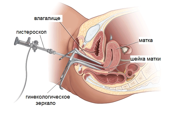 Как проводится диагностические выскабливание полости матки при гиперплазии эндометрия
